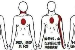 心绞痛是什么症状?,识别与应对冠心病警报